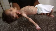 وفاة طفلين بسبب سوء التغذية والمجاعة في شمال وجنوب غزة