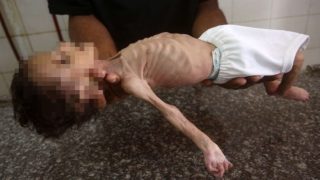 وفاة طفلين بسبب سوء التغذية والمجاعة في شمال وجنوب غزة