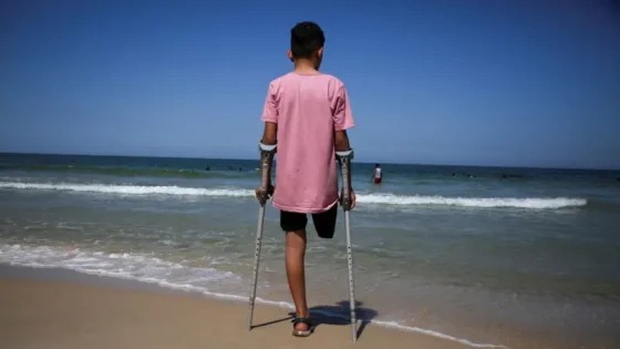 15 ألف مبتور أطرافهم واحتياجات طبية عاجلة في غزة